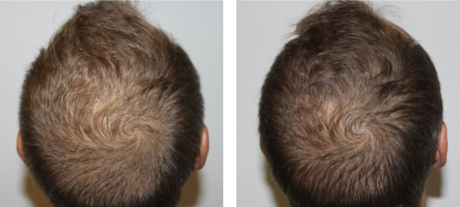 Keravive-BeforeAndAfter1 Keravive scalp treatment before and after