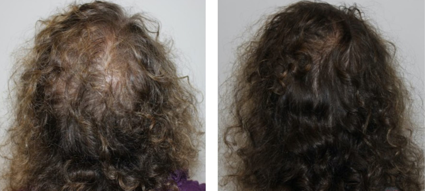 Keravive-BeforeAndAfter2 Scalp treatment to minimize thinning hair