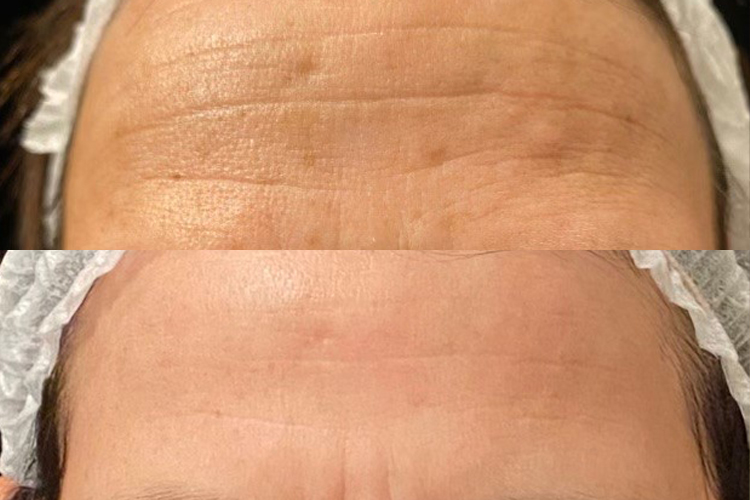 Opus-Before-After-Web-Desai-2txs Forehead skin after laser resurfacing treatment
