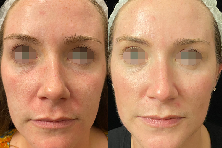 Opus-Desai-04-Post-2-txs-Web Laser skin resurfacing before and after