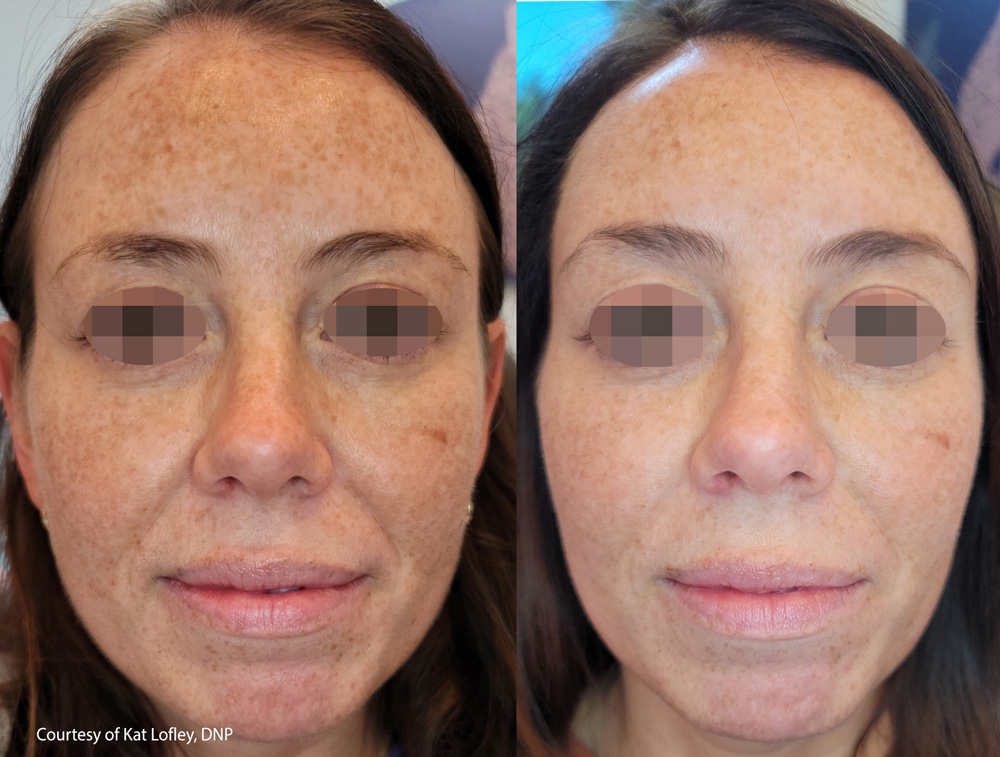 before-after-skin-tightening-1