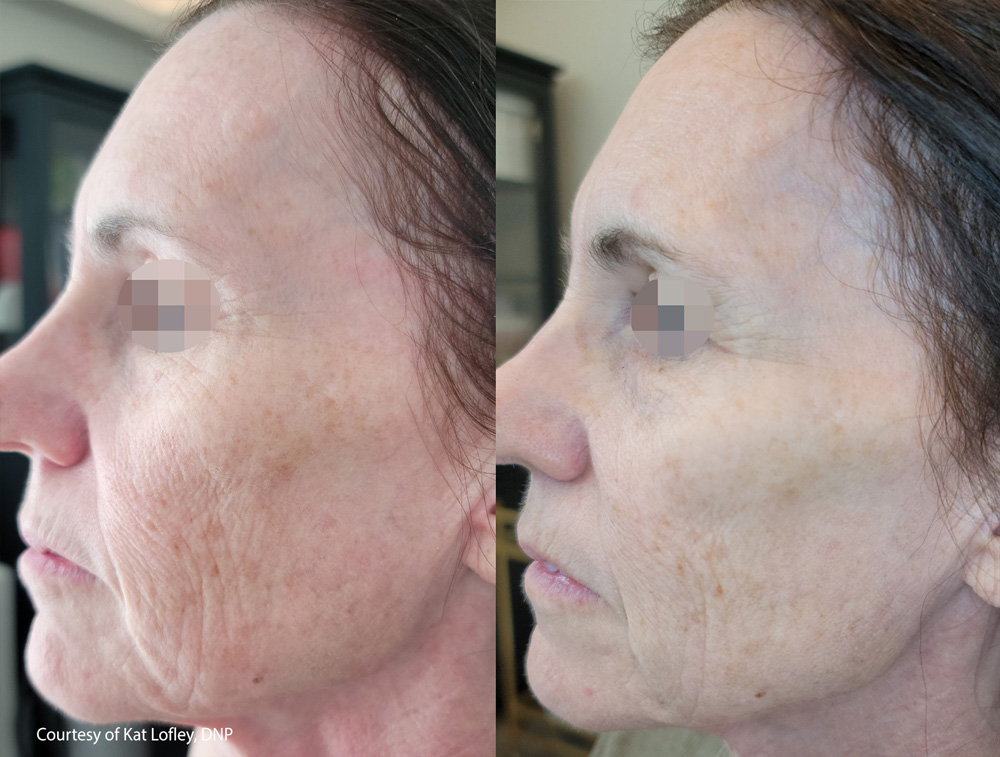 before-after-skin-tightening-2