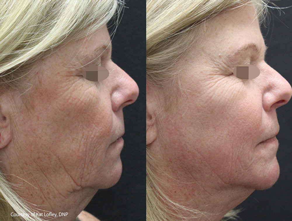 before-after-skin-tightening-3