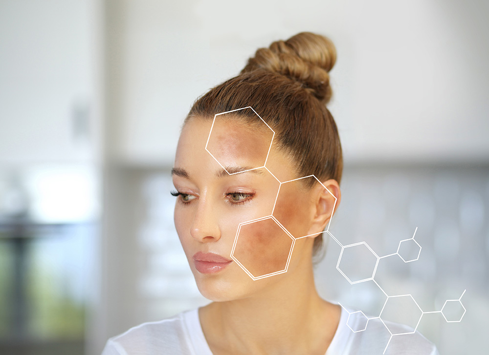 melasma-treatment-idahofalls