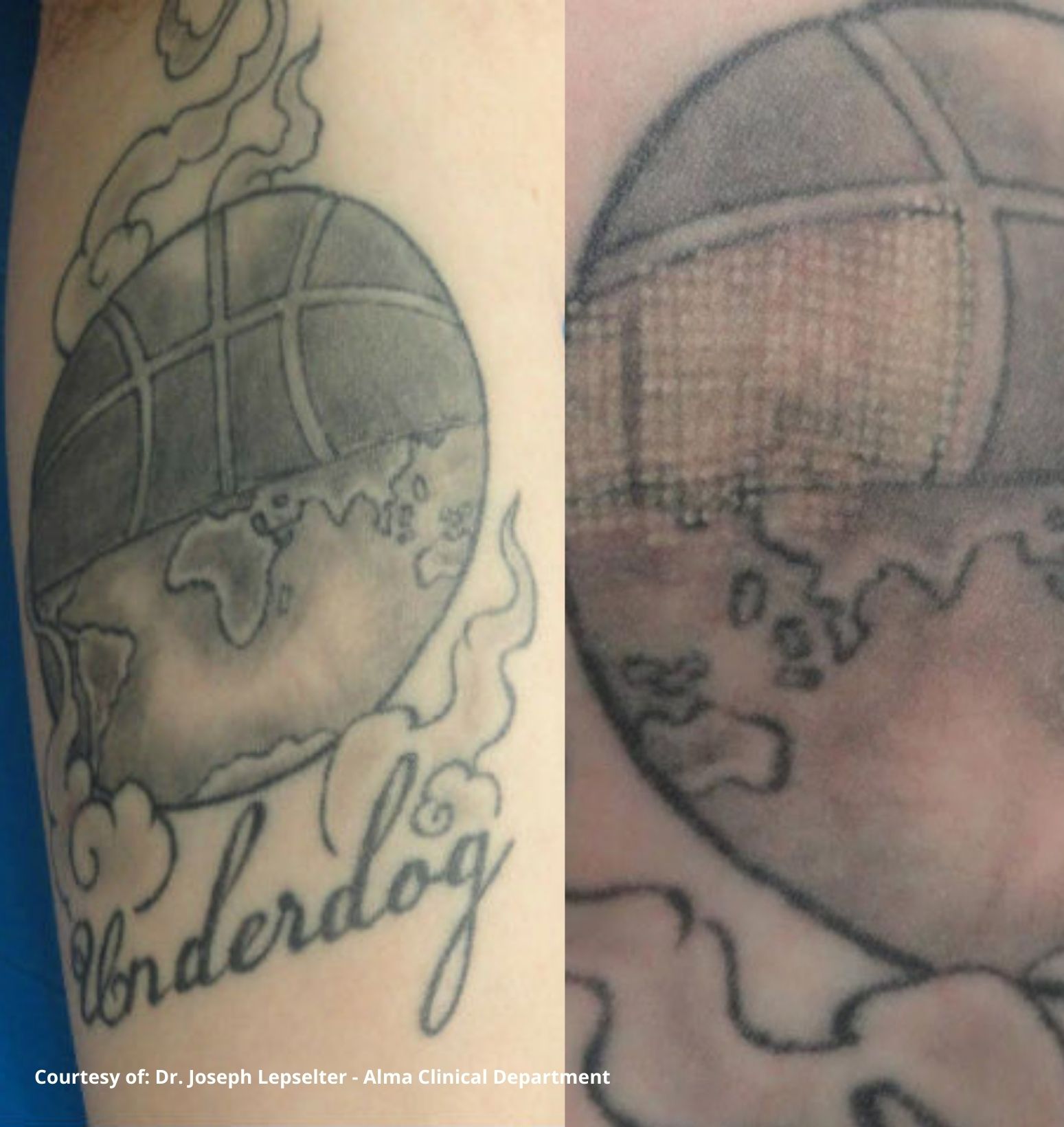 tatoo-removal-treatment-before-after