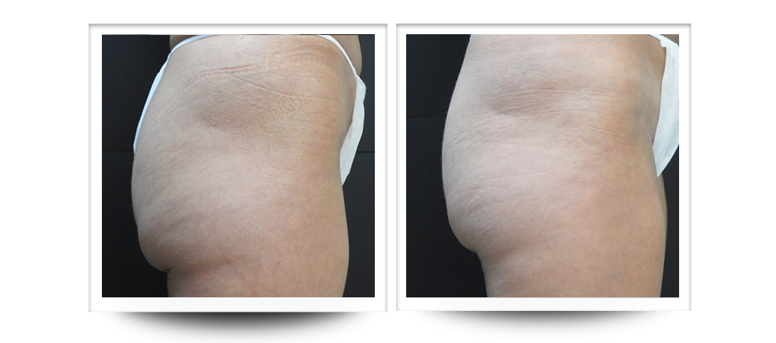 Body Sculpting - Buttocks Before & After Body Sculpting | Buttocks Cellulite Results