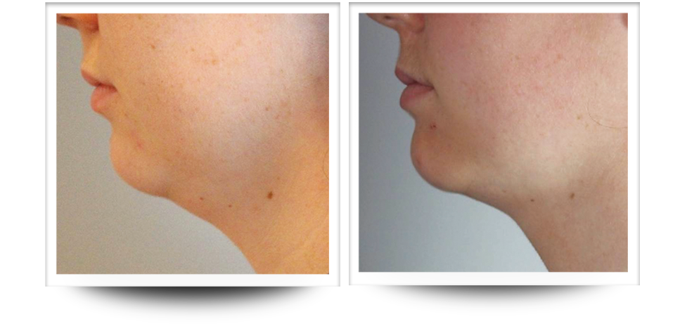 Body Sculpting - Neck Before & After Body Sculpting | Neck Before & After