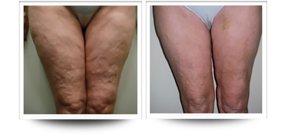 Body Sculpting - Legs Before & After Body Sculpting | Legs Before & After