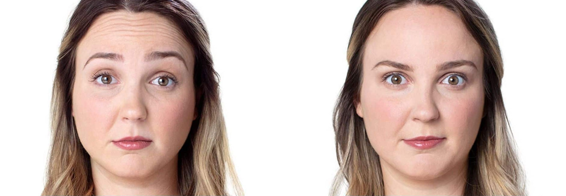 botox-before-and-after-forehead-lines Botox before and after forehead lines