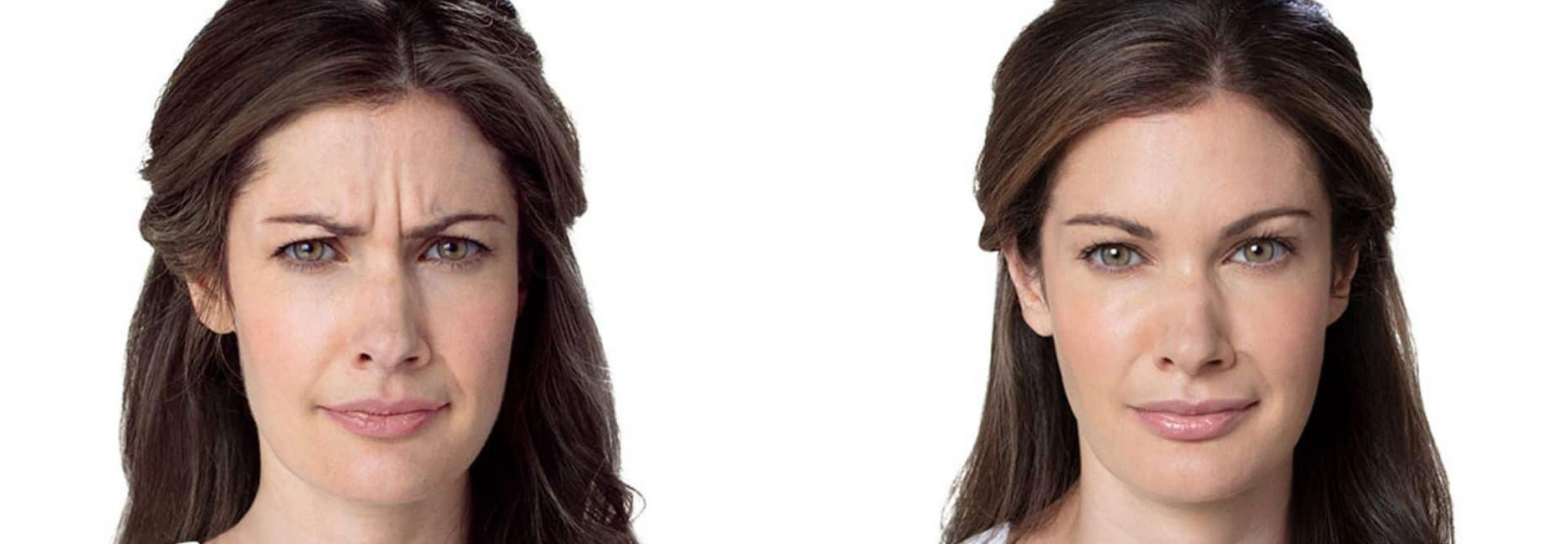 botox-results-crows-feet-and-wrinkles Botox before and after crows feet and fine lines