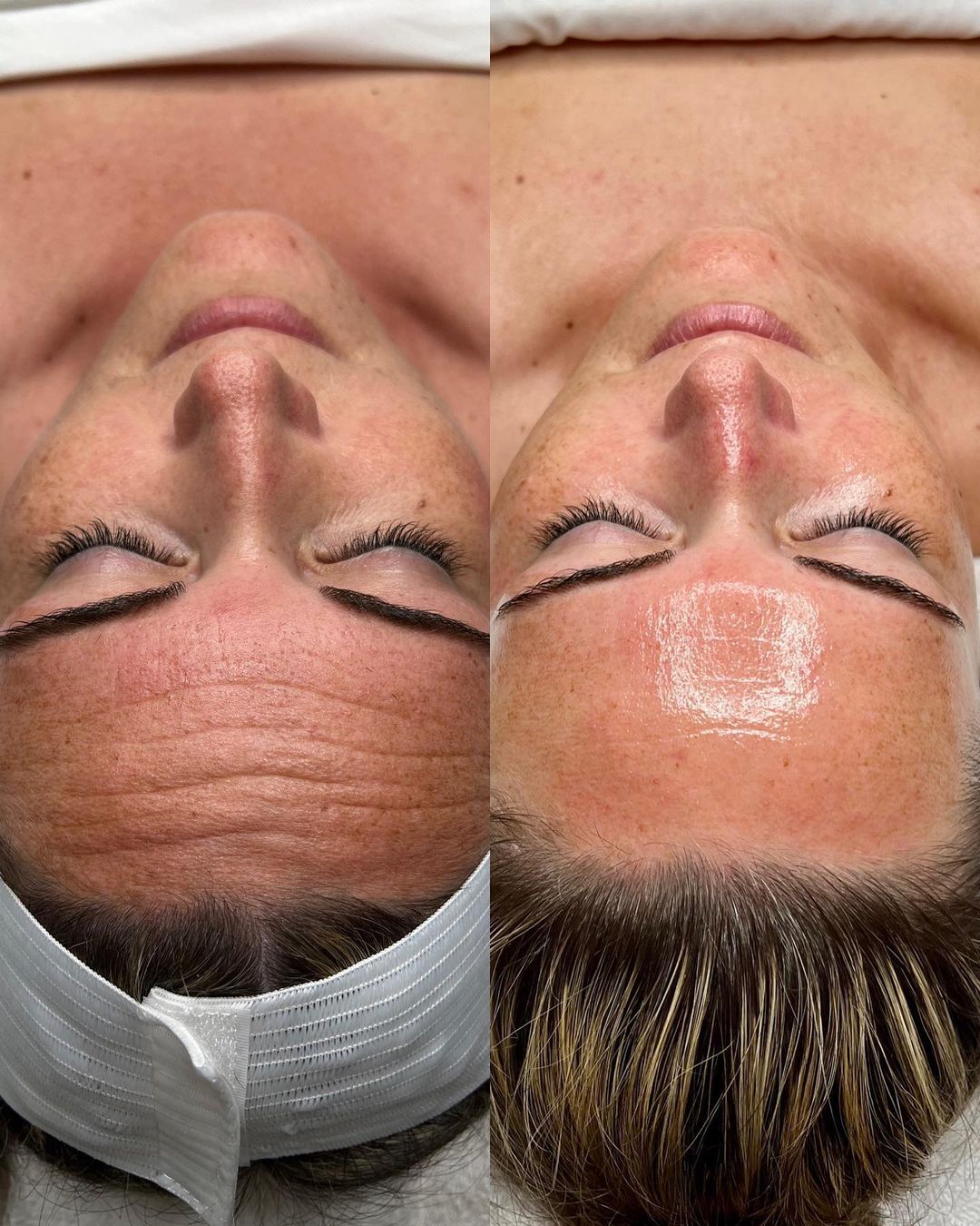 Laser skin resurfacing before and after