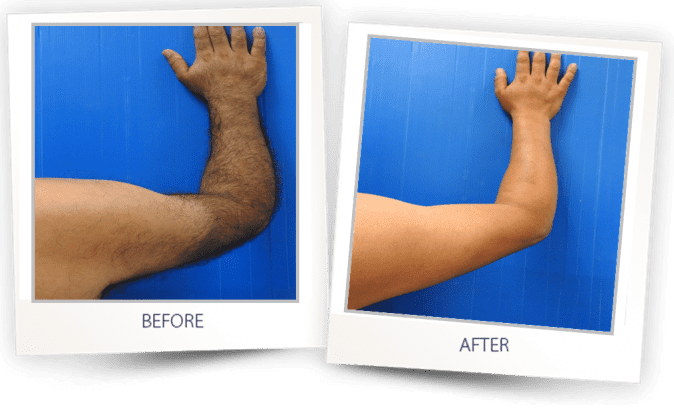 before-after-lhr-1 Laser skin resurfacing before and after