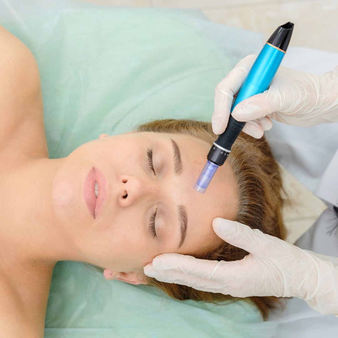 microneedling stock photo 2