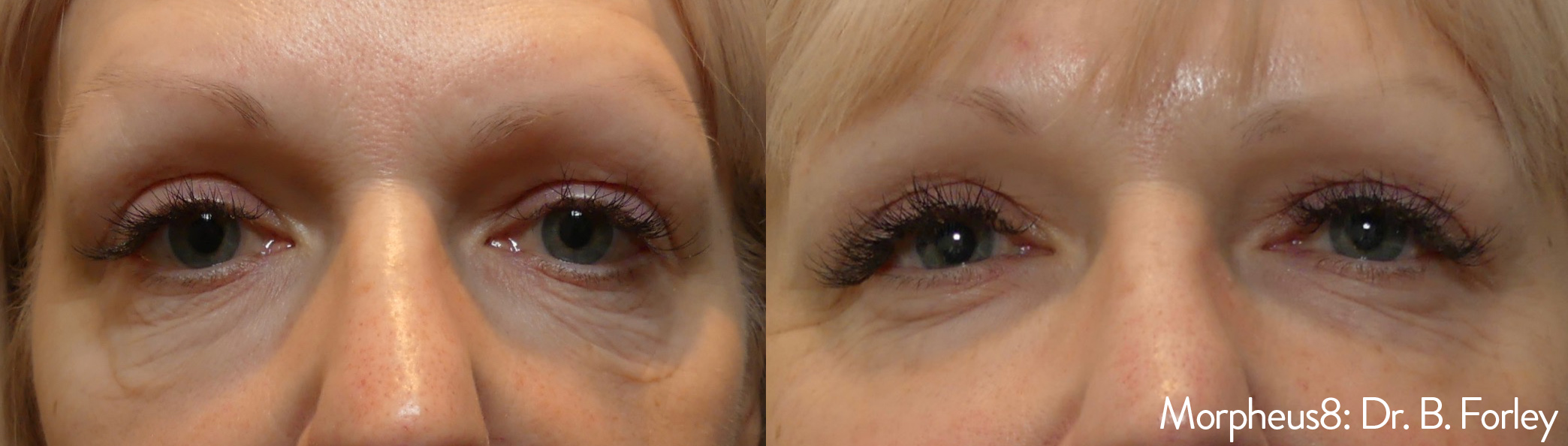 Morpheus8 Under Eye Before | After Photos 7 Morpheus8 Under Eye Before/Afters