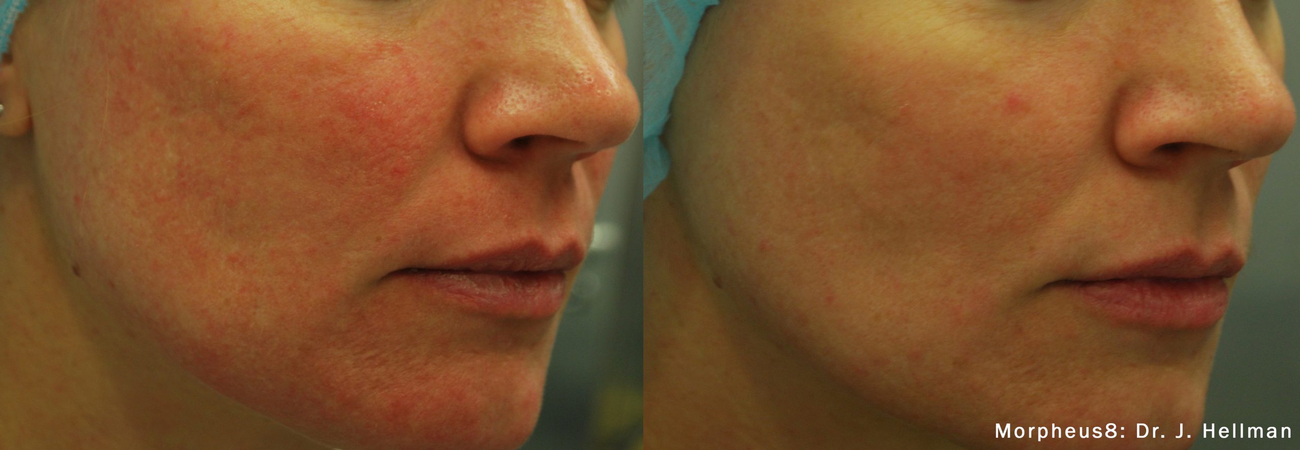 Morpheus8 Face Before | After Photos 6 Morpheus8 Skin Treatment Before/Afters