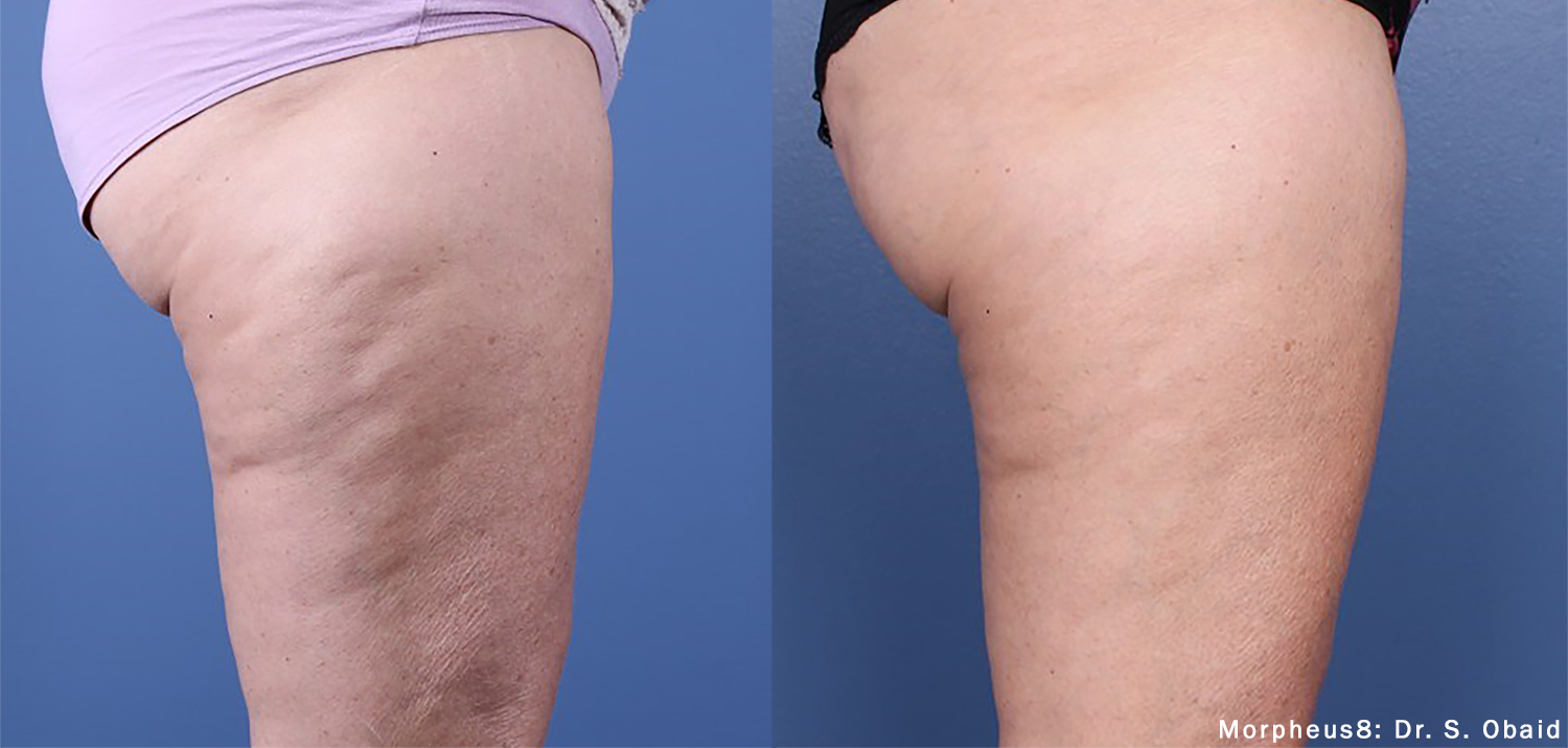 Morpheus8 Body Cellulite Treatment Before | After Photos Morpheus8 Body Cellulite Treatment