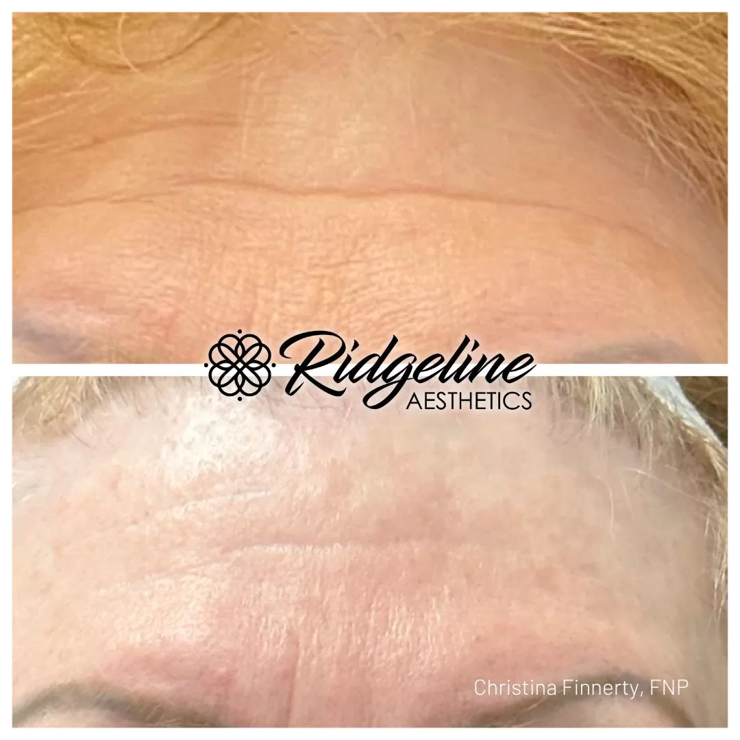 Ridgeline-Before-After-Opus-Forehead