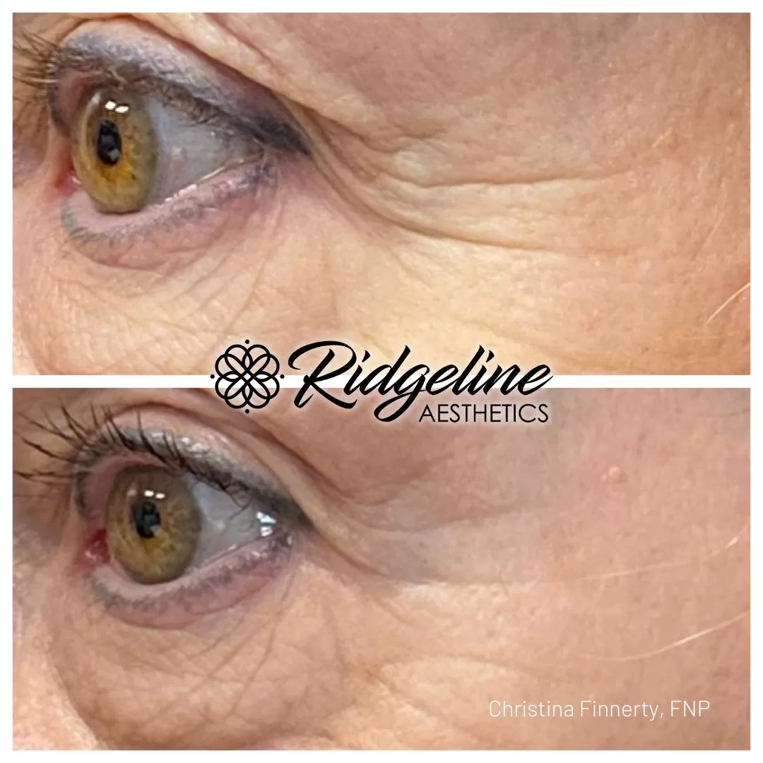 Ridgeline-Before-After-Opus-UnderEye-12