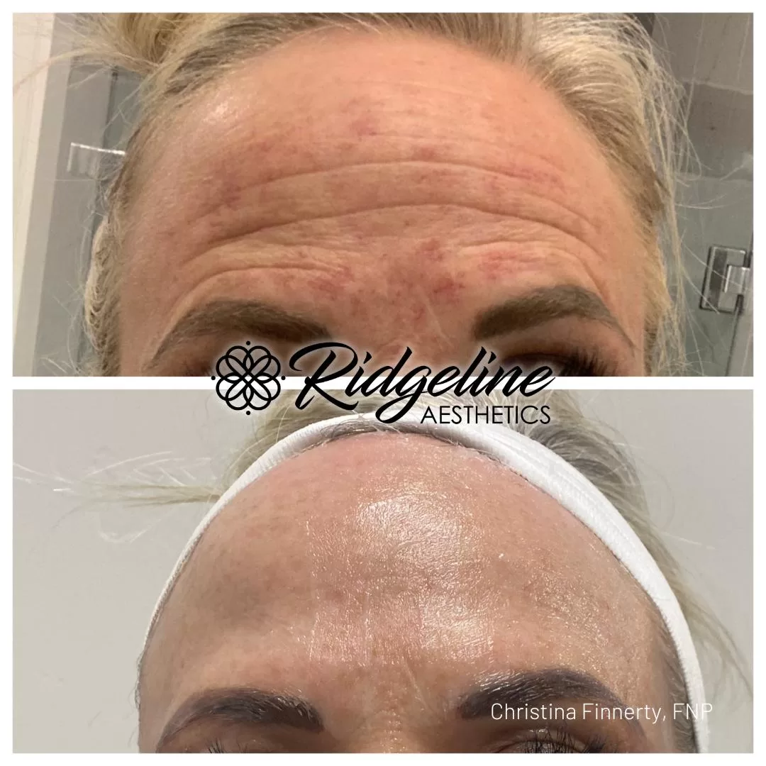 Skin-Tightening-Before-After-Opus-Ridgeline2
