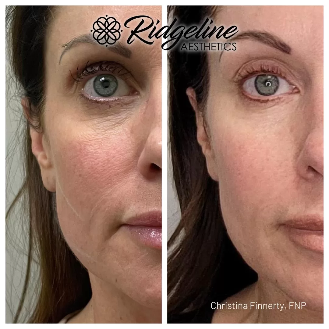 Skin-Tightening-Before-After-Opus-Ridgeline4