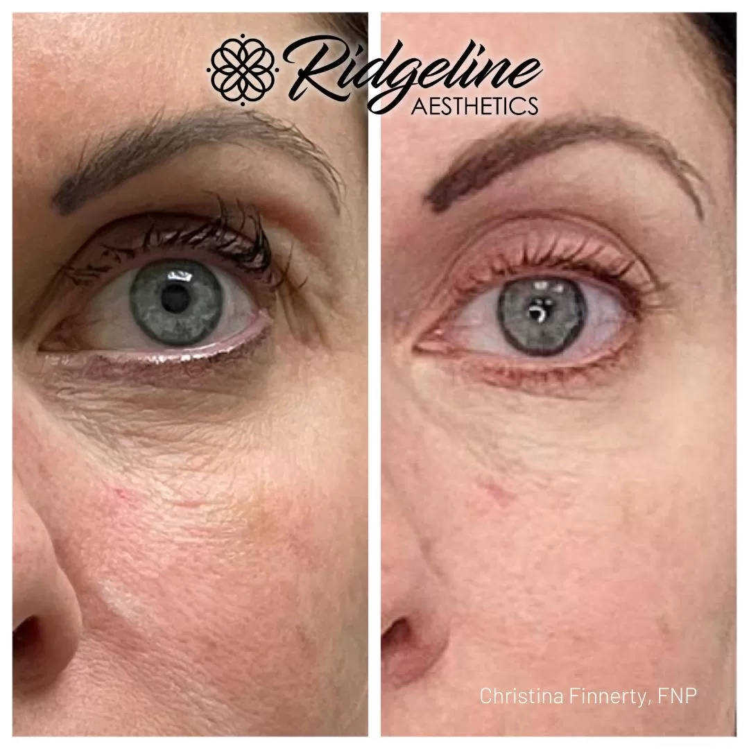 Skin-Tightening-Before-After-Opus-Ridgeline5