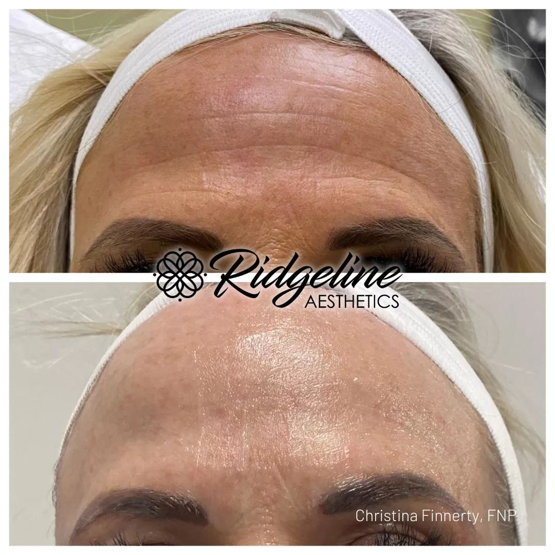 Skin-Tightening-Before-After-Opus-Ridgeline7