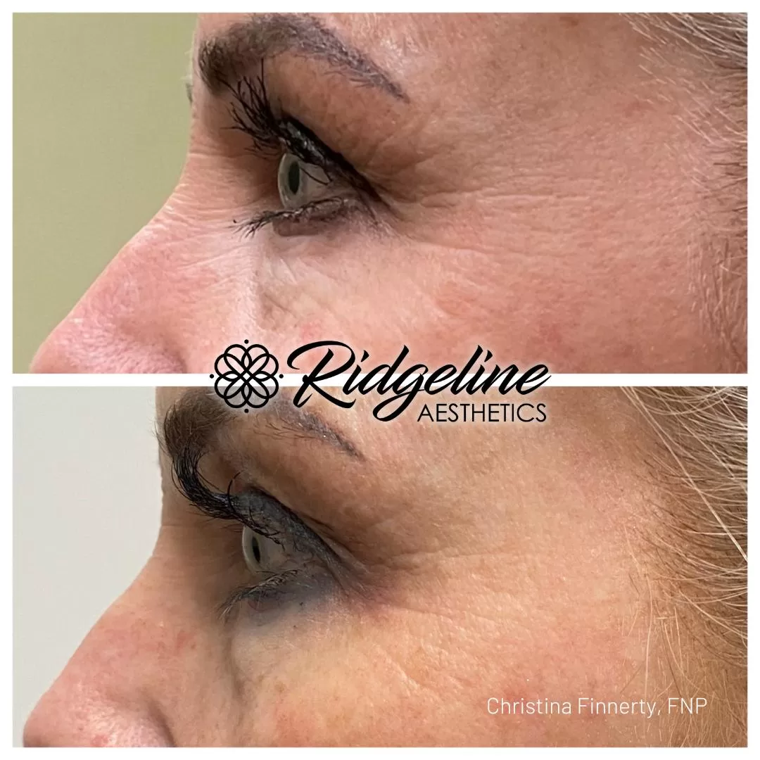 Skin-Tightening-Before-After-Opus-Ridgeline8