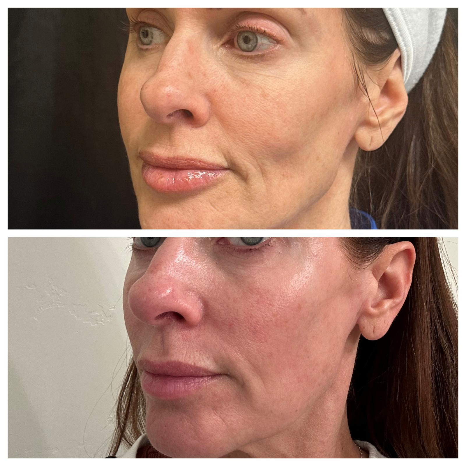 Facial balancing before and after, three-quarter view: smoother nasolabial folds and refreshed midface volume