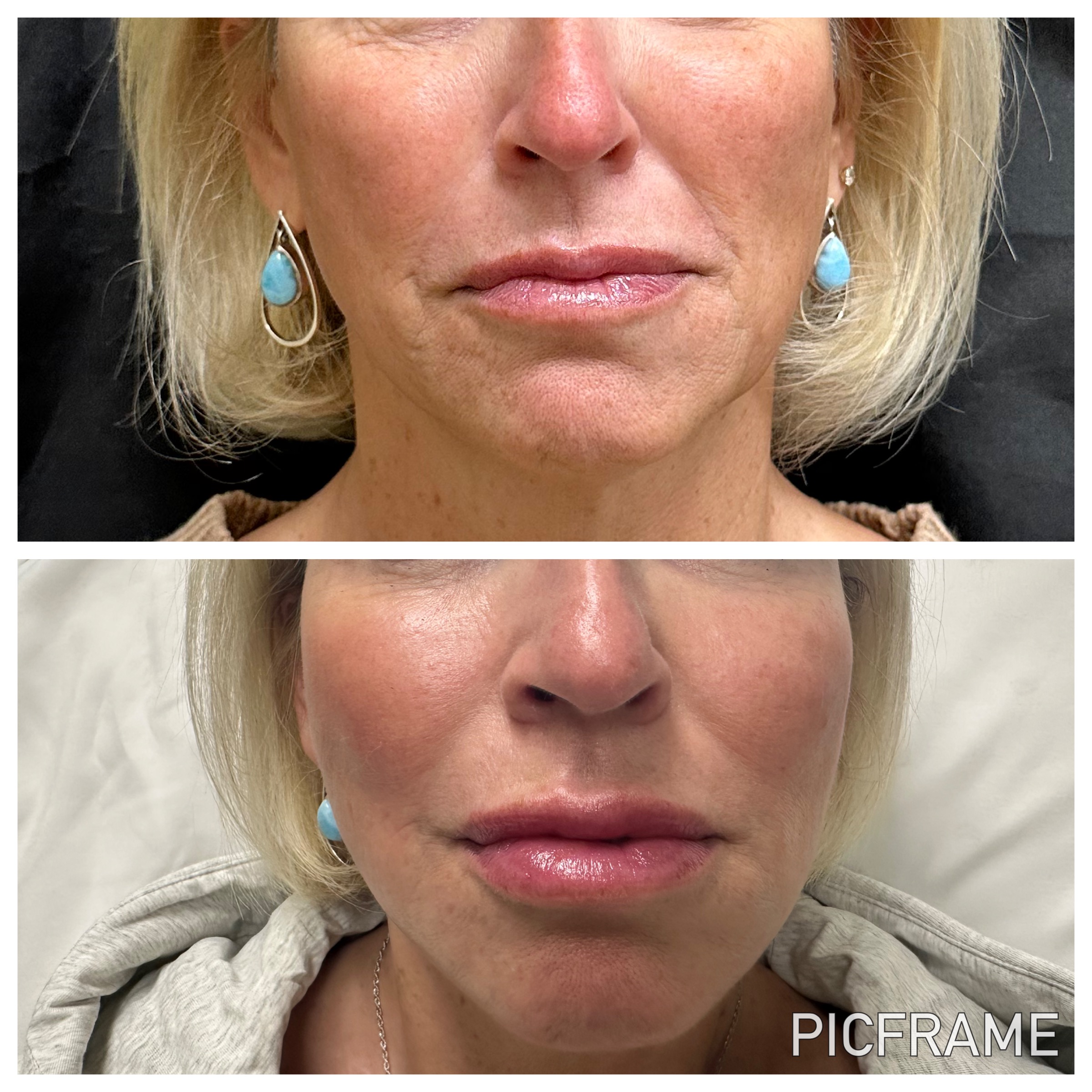 Front-view before-and-after comparison of lip volume and lower-face balance.