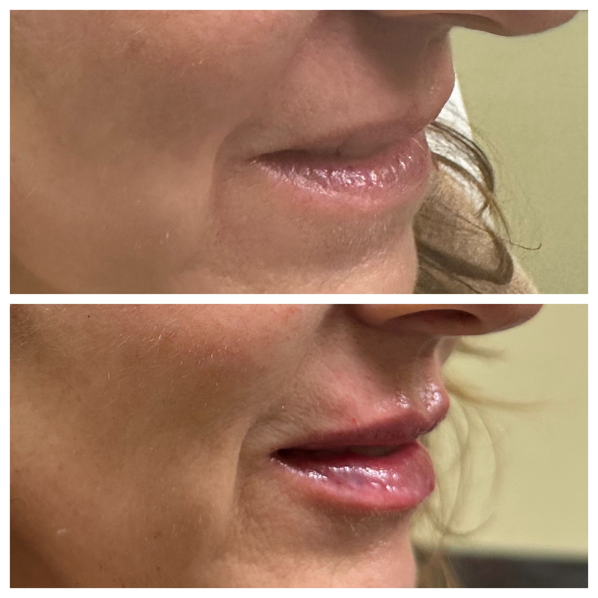 Before and after comparison of facial skin texture and radiance