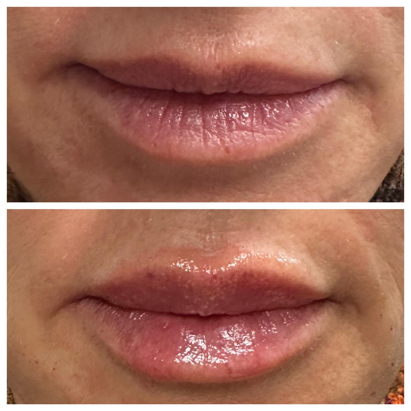 Close-up lip filler before and after: added upper lip volume and definition