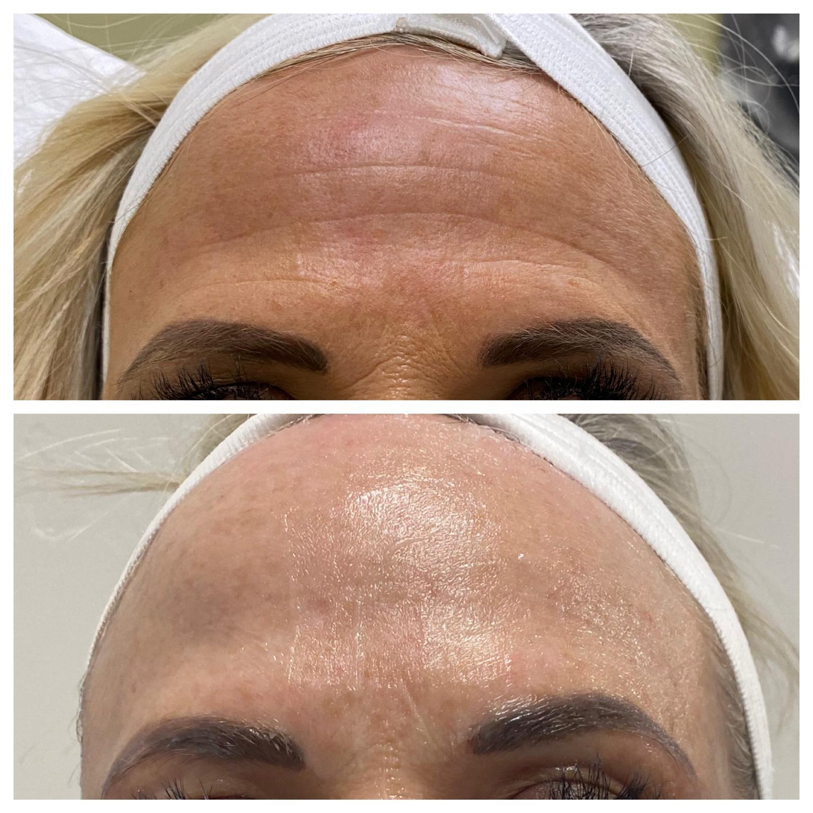 Before-and-after comparison of forehead lines.