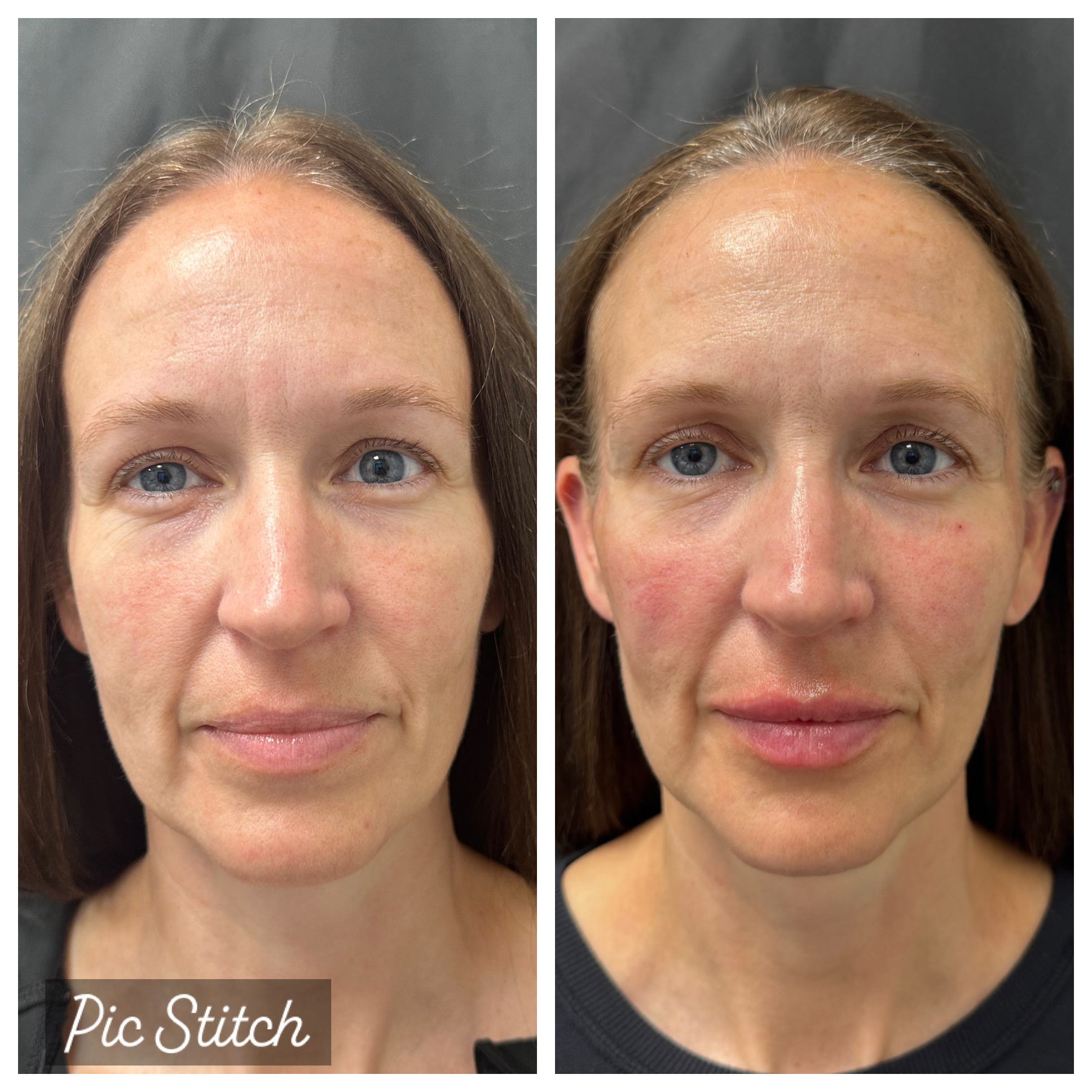 Before and after full-face refresh and lip enhancement for a Ridgeline patient