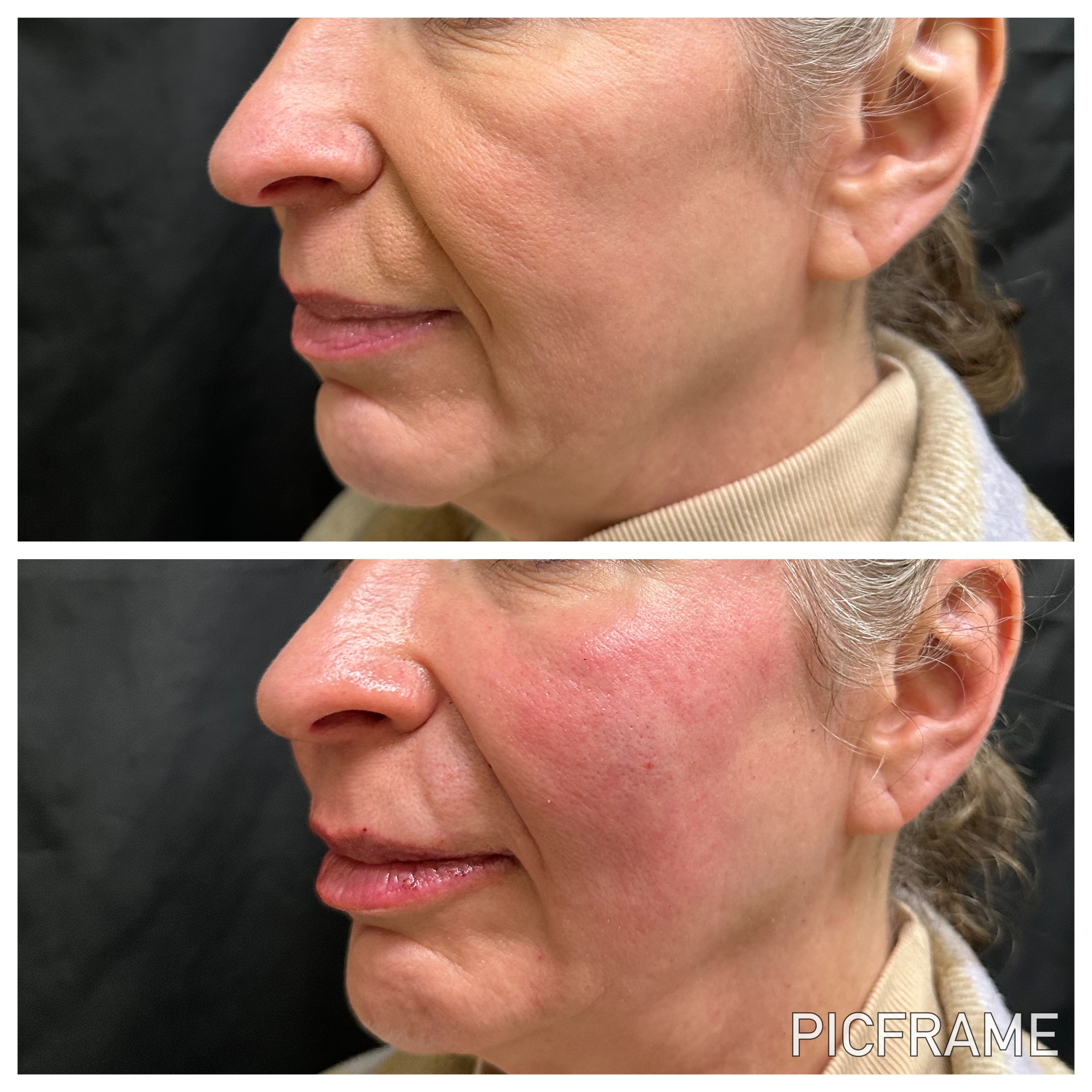 Stacked side-profile views of the lower face showing changes in skin tone and texture at Ridgeline Longevity & Aesthetics.