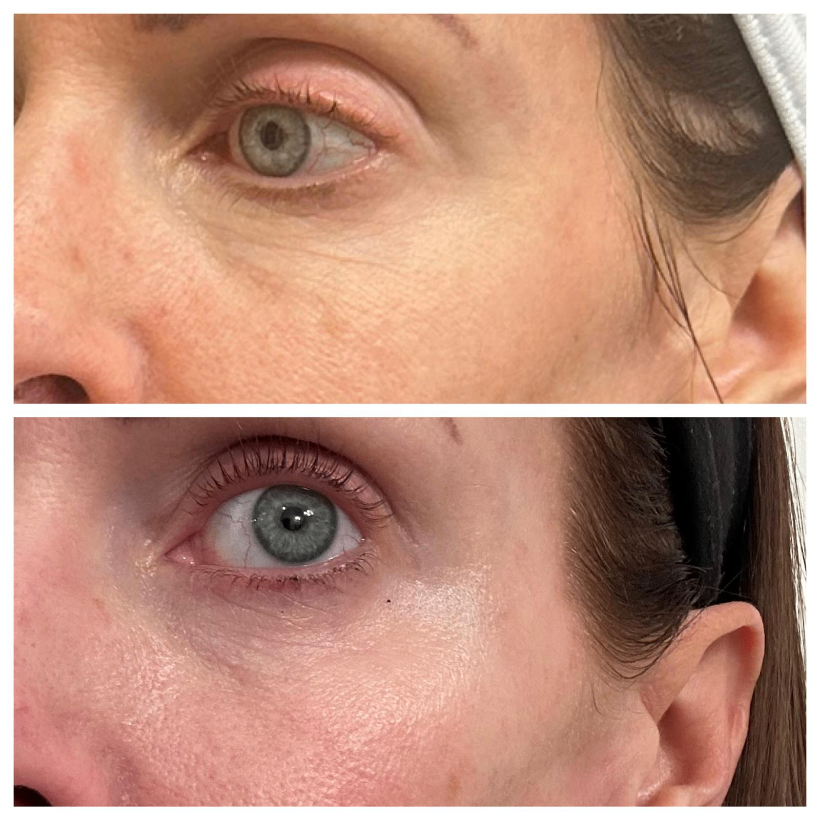 Before and after close-up: softened under-eye and crow's feet lines with brighter skin texture