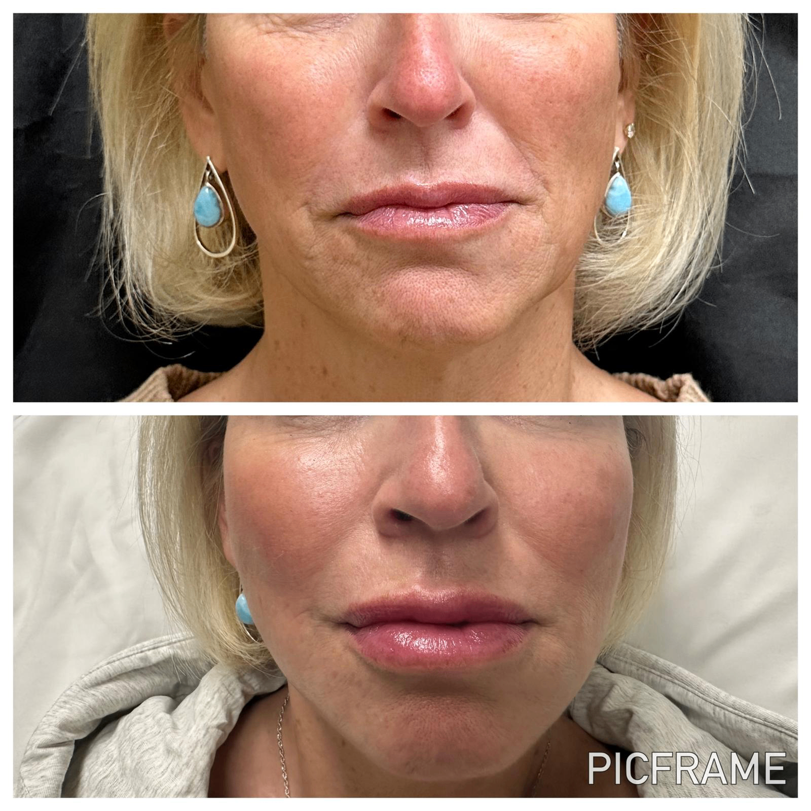 Lip filler before and after: fuller lip volume and softened perioral lines