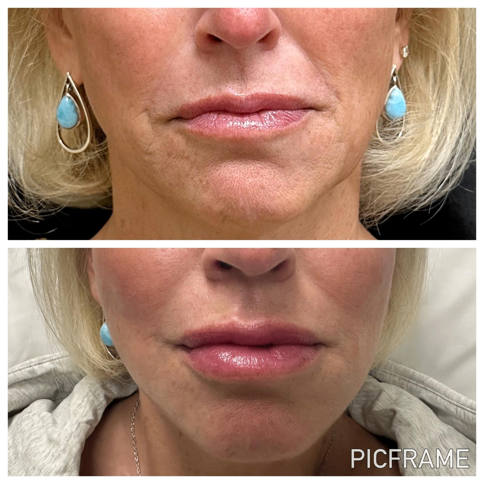 Facial balancing before and after: restored lip and perioral volume with softer lines around the mouth
