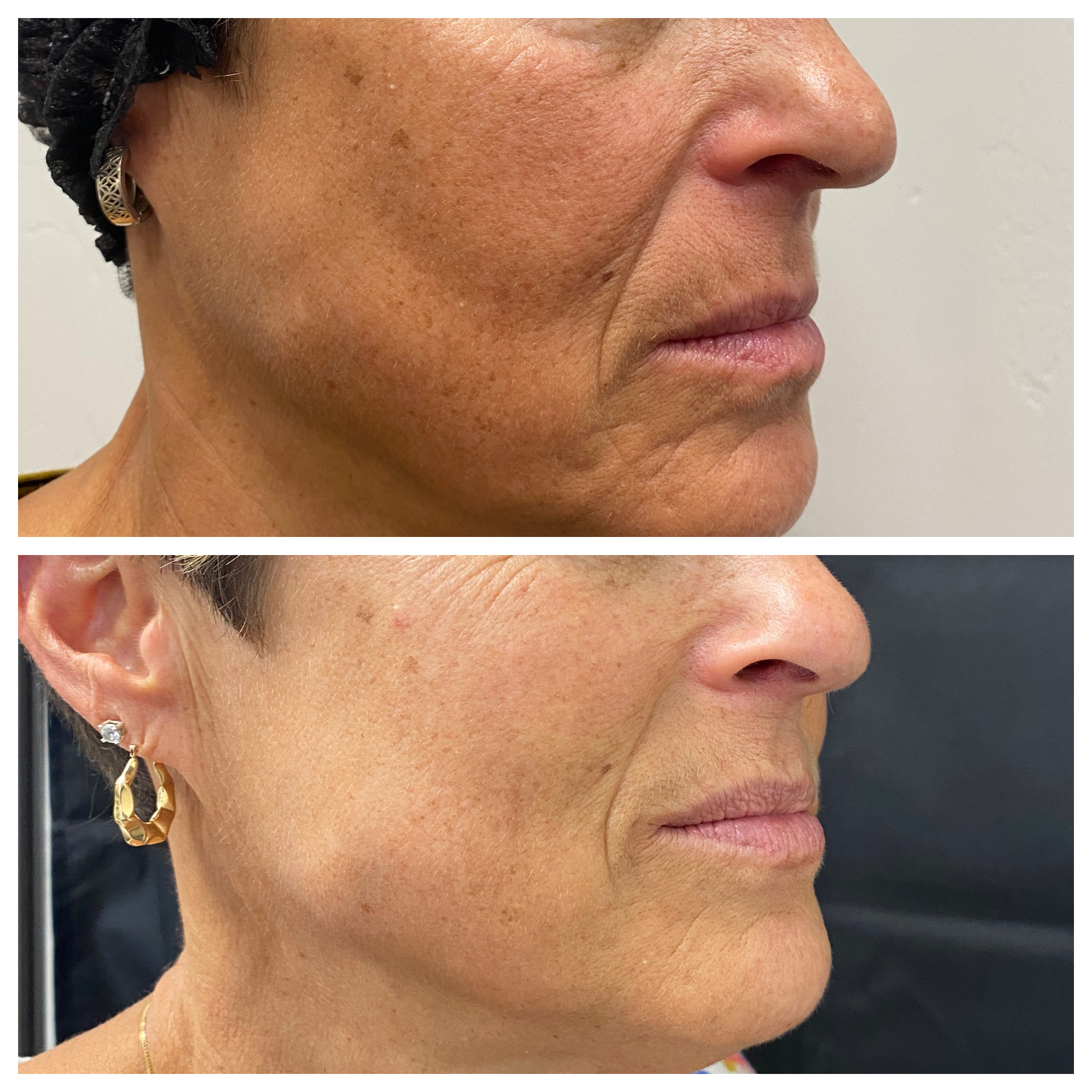 Before and after side profile of lower face and neck skin firmness for a Ridgeline patient