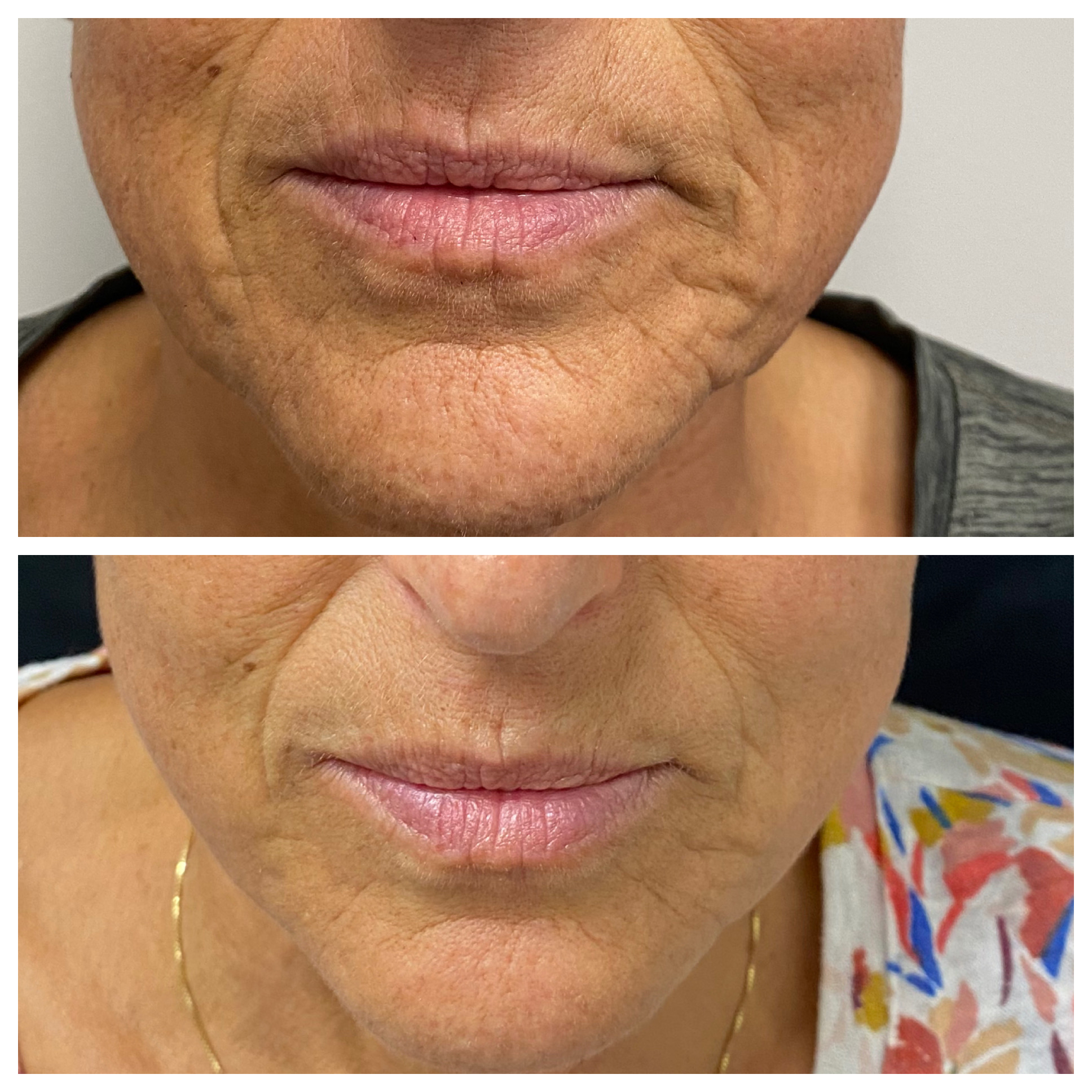 Before and after comparison of lower-face and lip area after a filler service.
