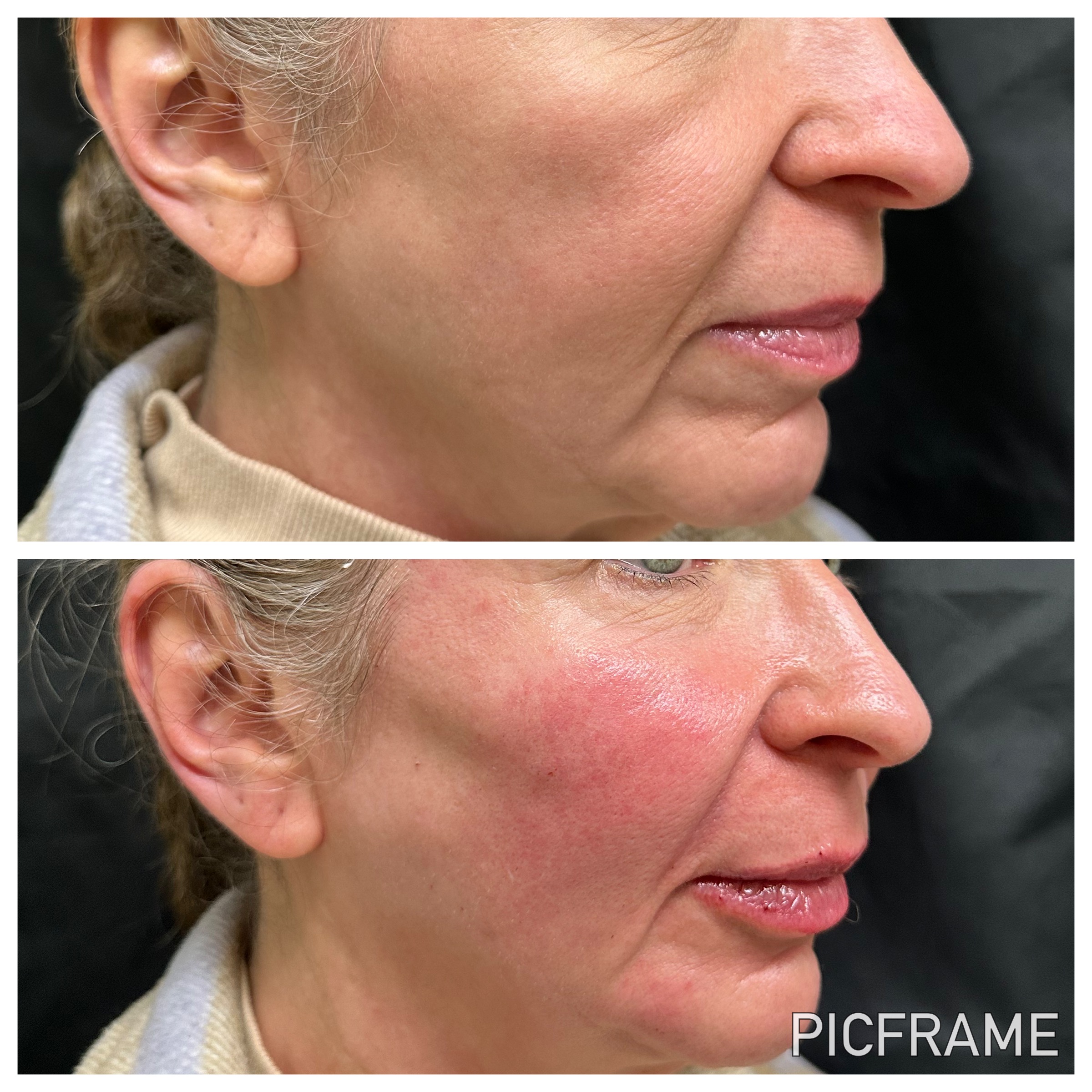 Side-profile before-and-after comparison of lower-face and jawline contour.