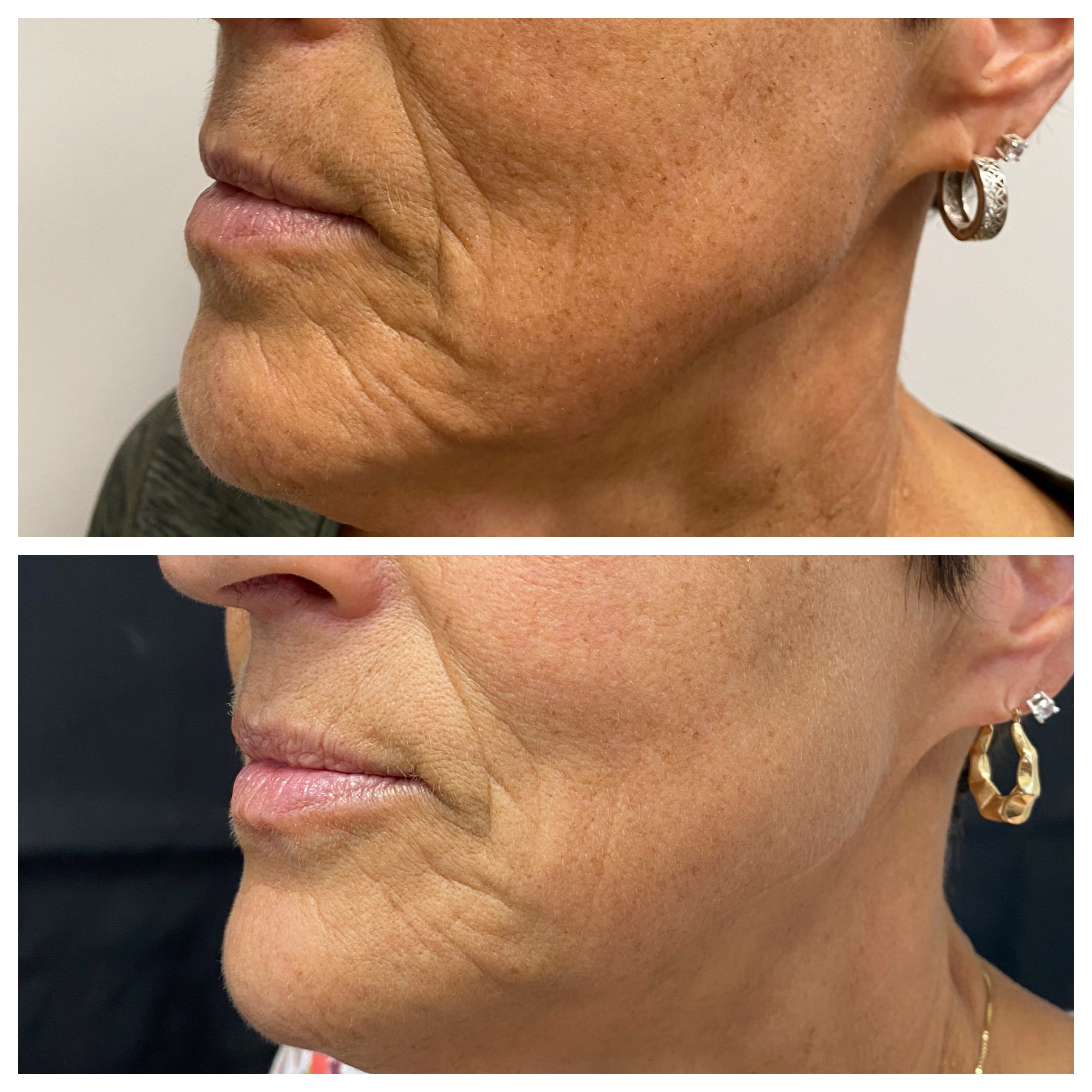 Before and after side profile of lower face and neck firmness for a Ridgeline patient