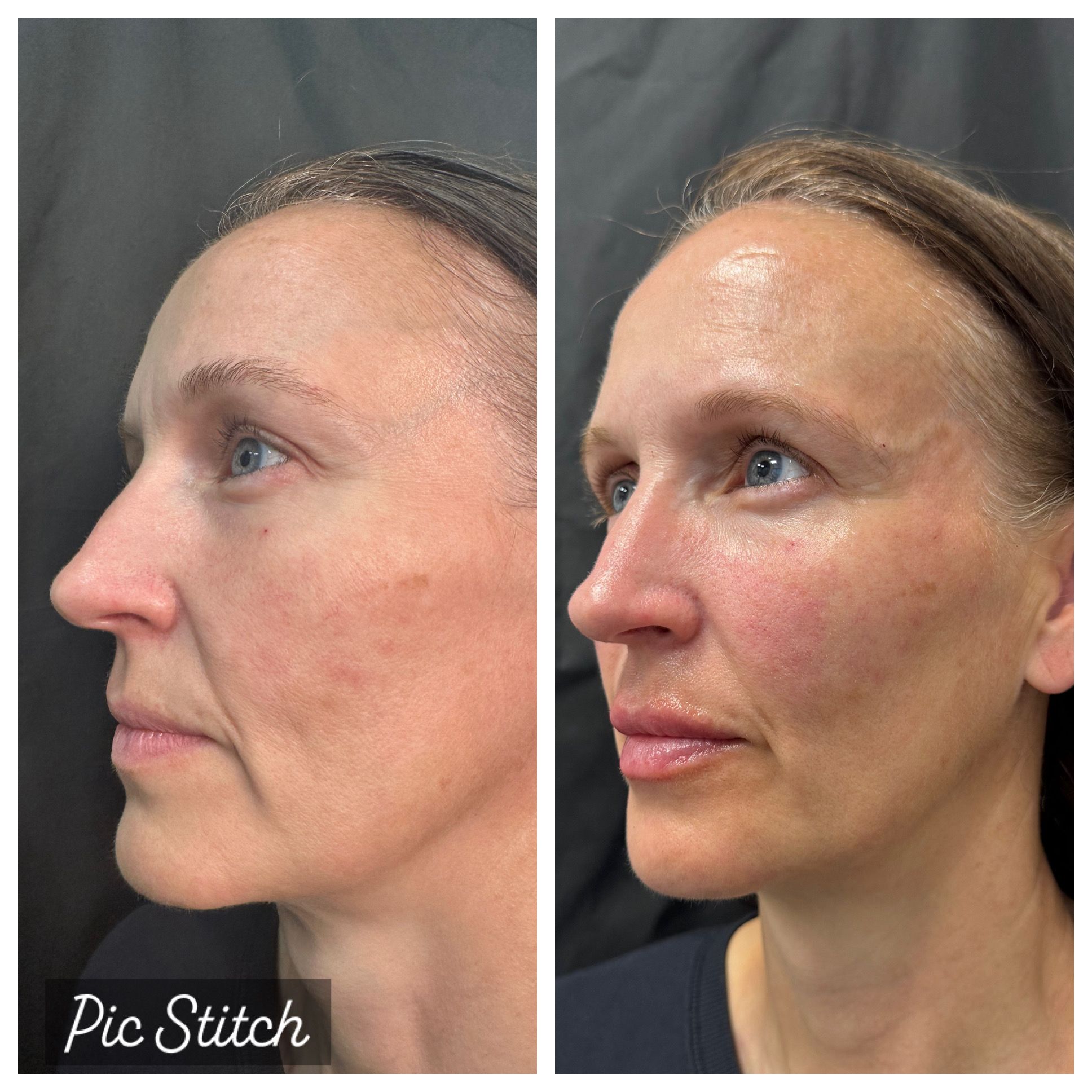 Side-by-side before and after of facial skin tone and texture following a skin service.