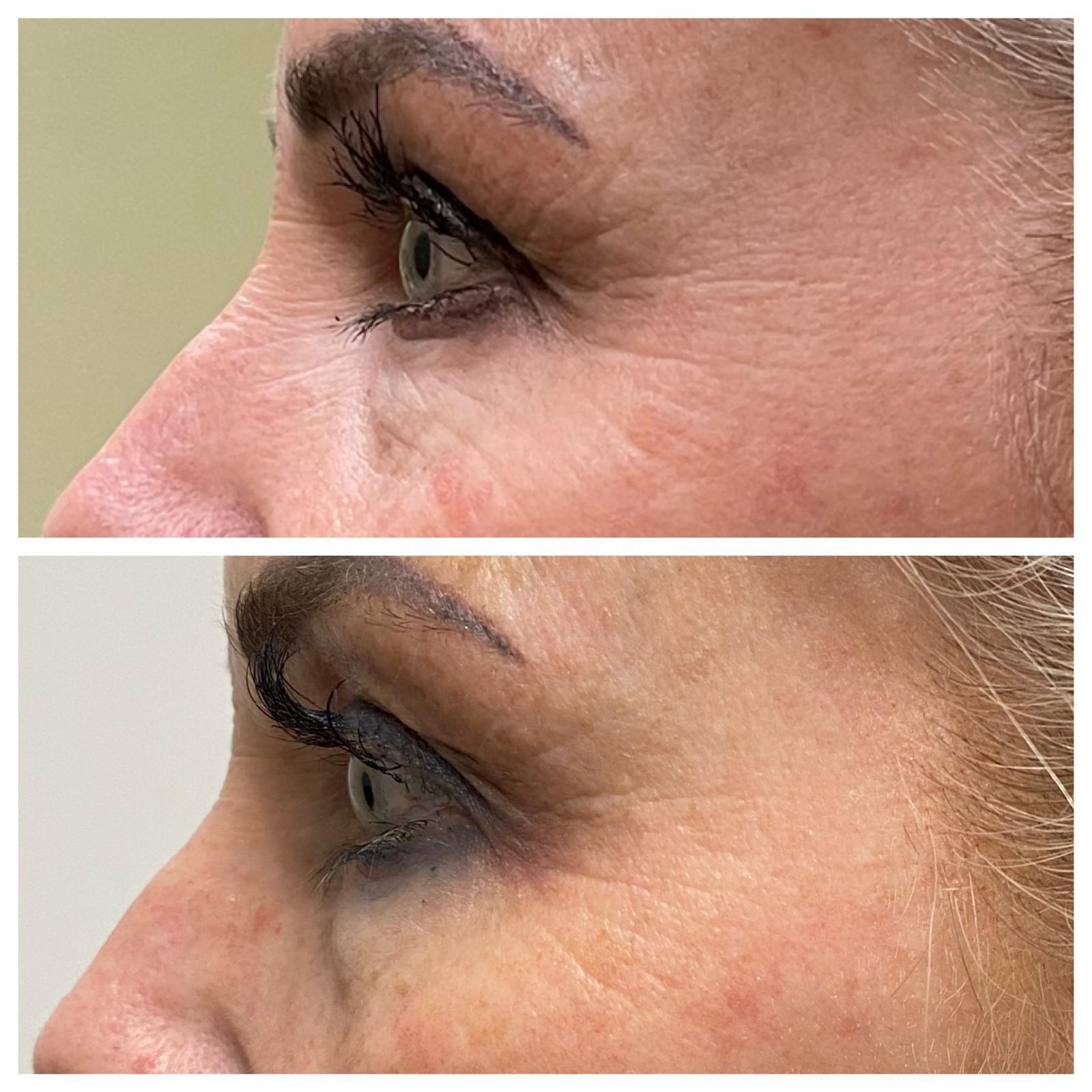 Before-and-after side view of the brow and outer-eye fine-line area.