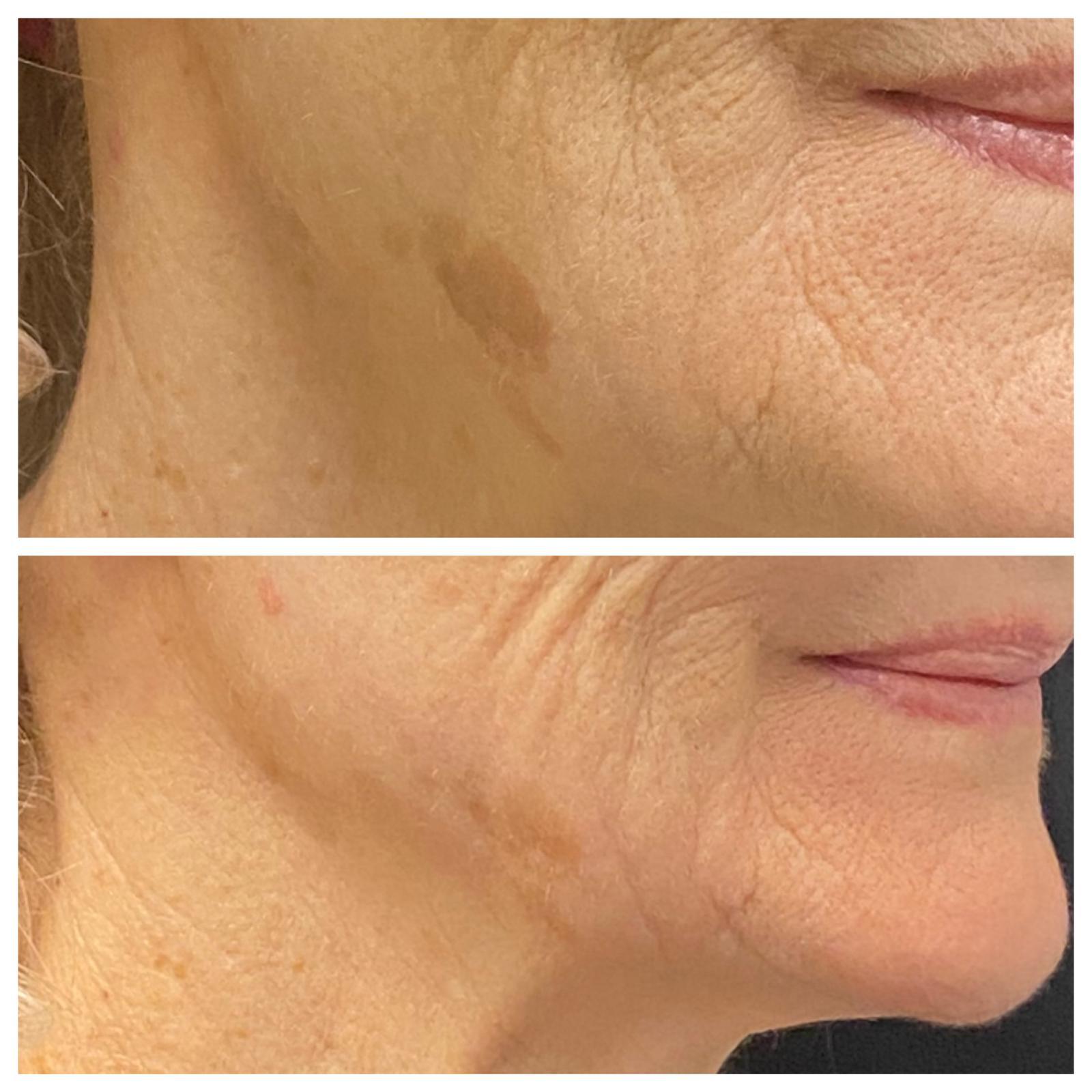 Before-and-after comparison of cheek and neck skin tone and texture.
