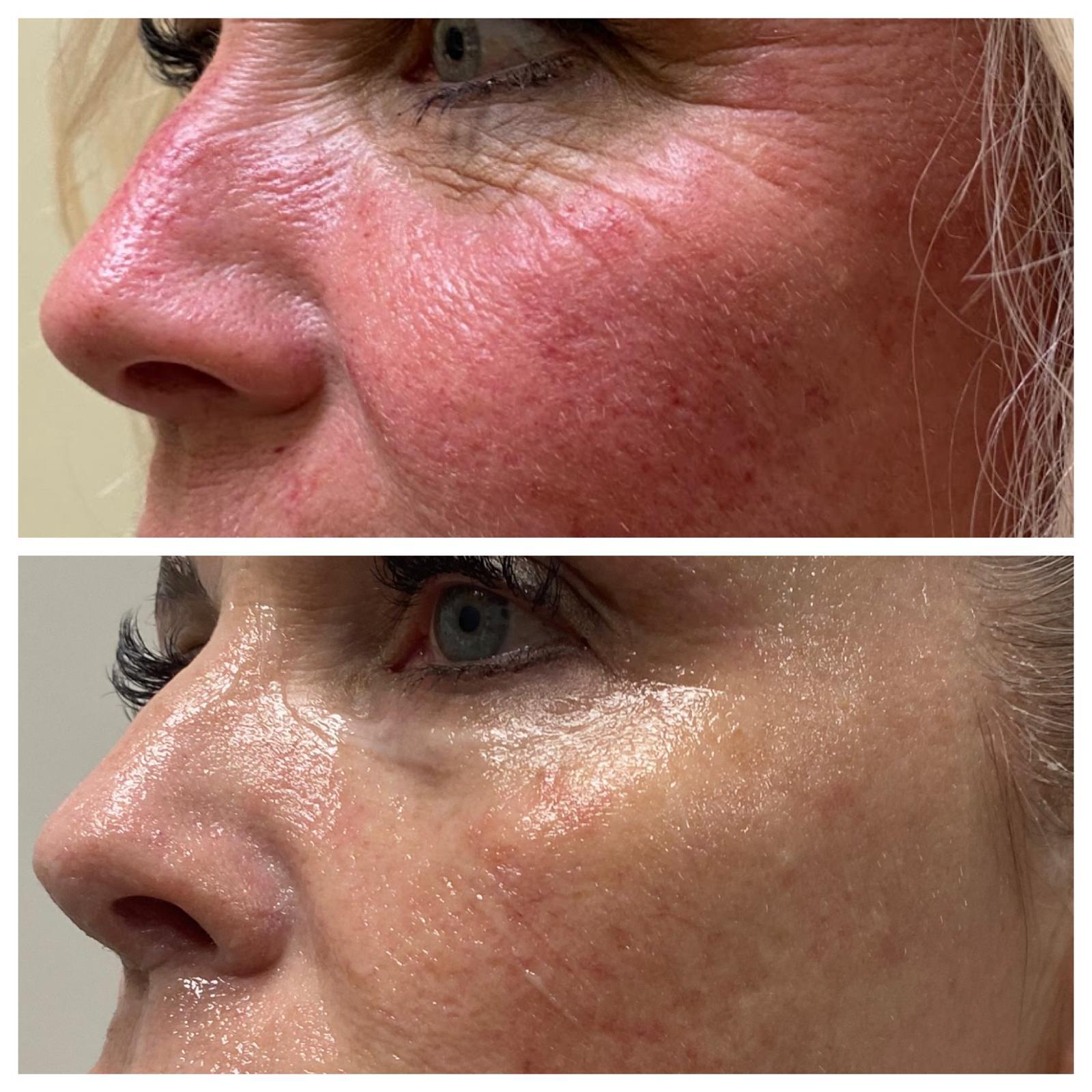 Before-and-after comparison of cheek redness and skin tone.