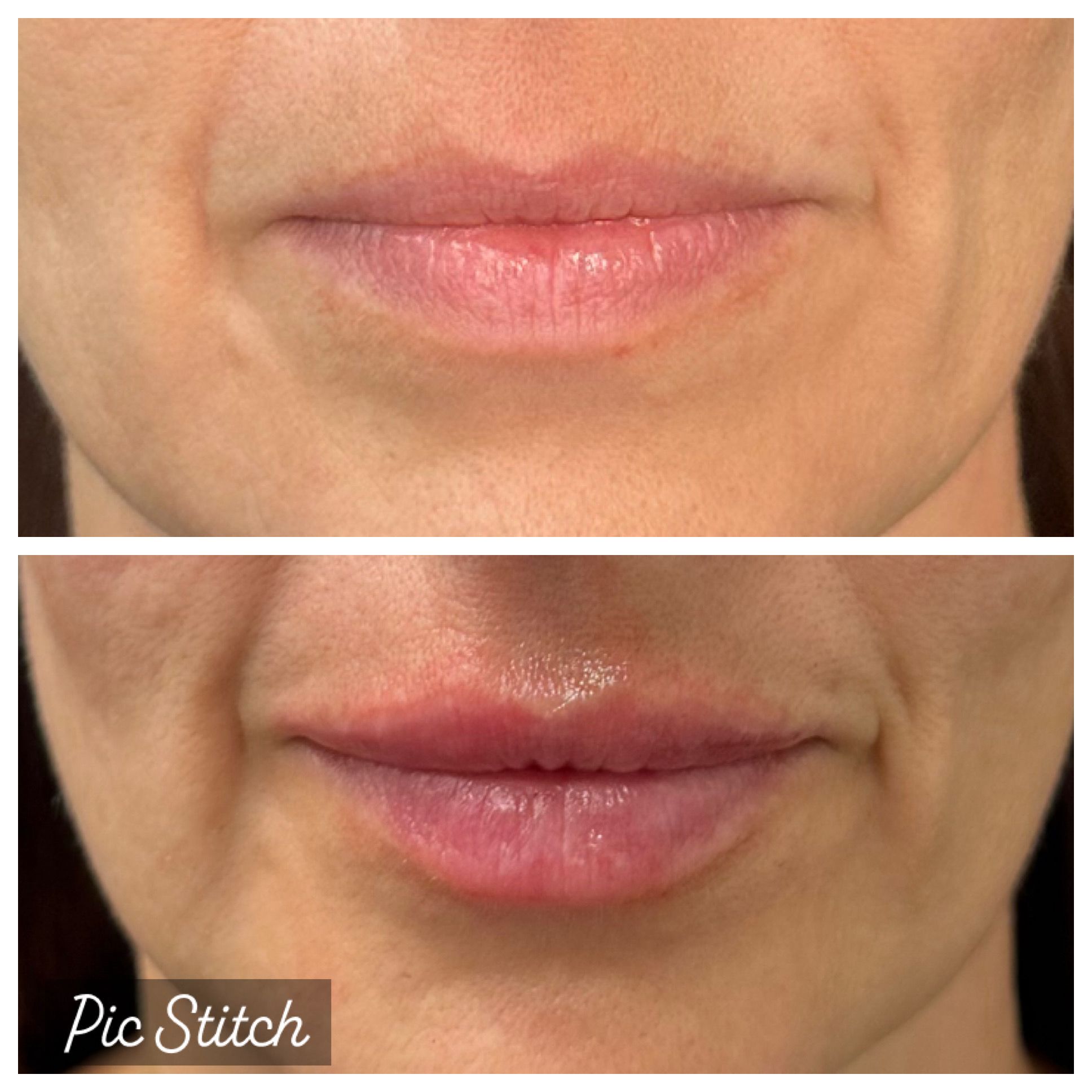 Before and after comparison of facial fine lines and skin smoothness