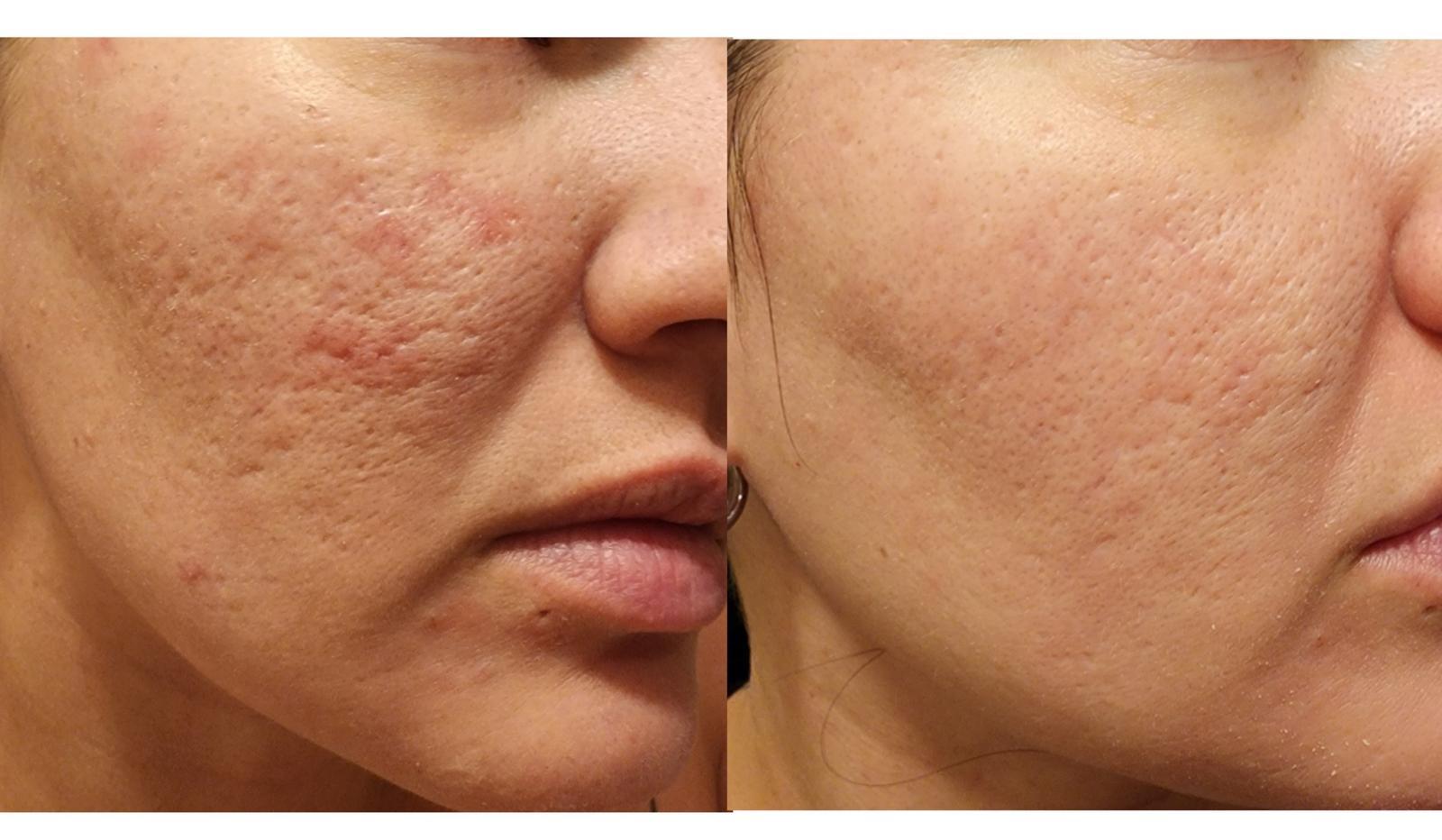 Side-by-side close-ups of the cheek showing changes in skin texture and scarring at Ridgeline Longevity & Aesthetics.