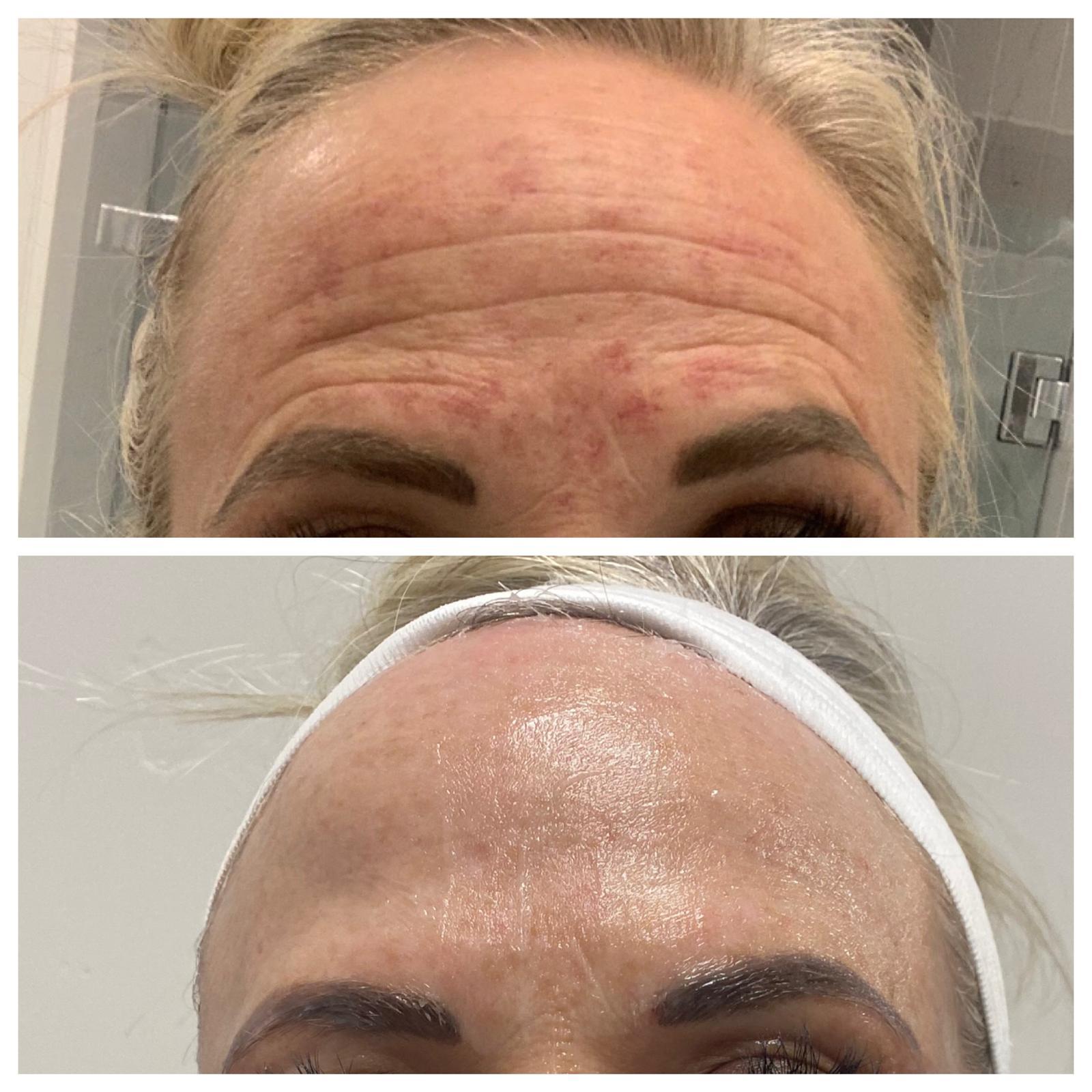 Stacked close-ups of the forehead showing changes in skin clarity and tone at Ridgeline Longevity & Aesthetics.