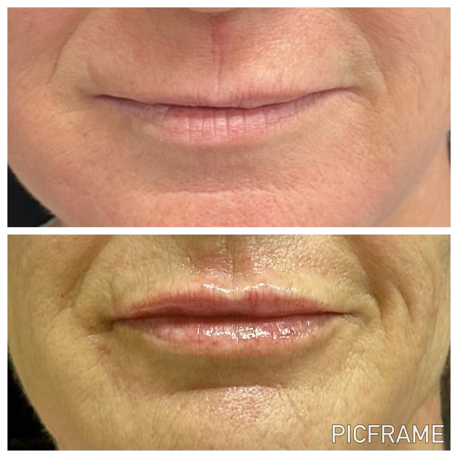 Lip filler before and after: restored lip fullness and softer lip lines