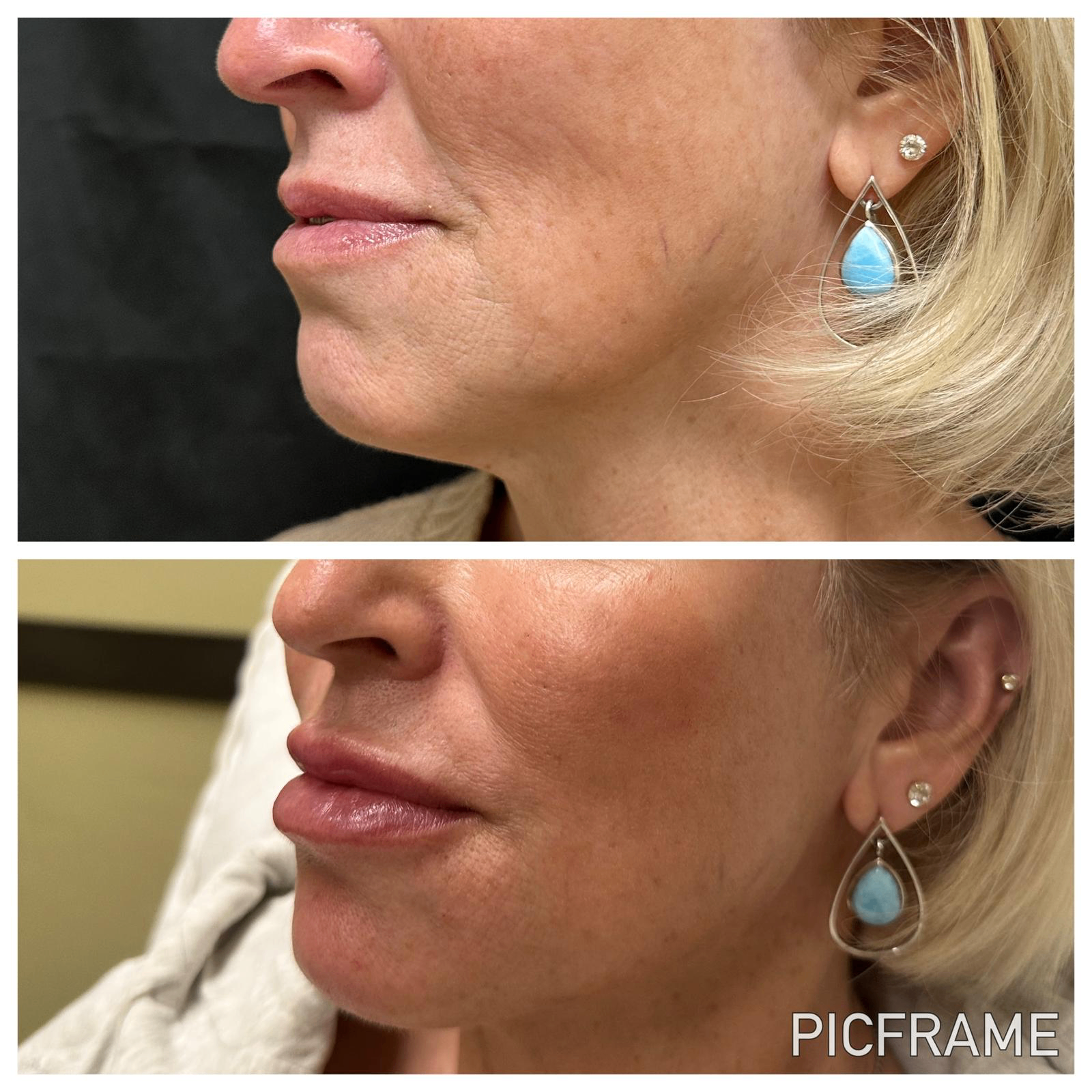 Lip filler results, three-quarter profile: improved lip shape and smoother corners